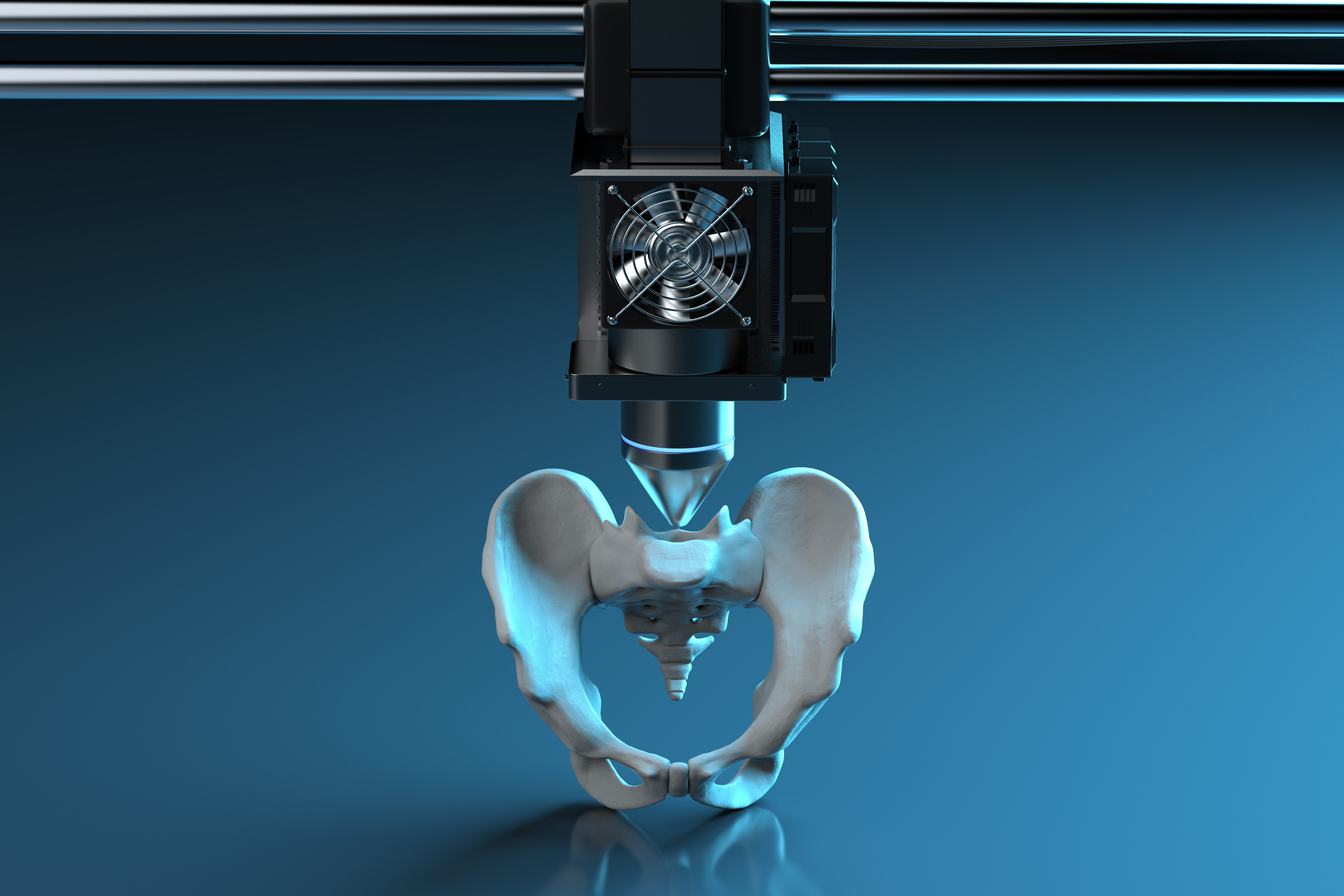 3D printing for hip implants